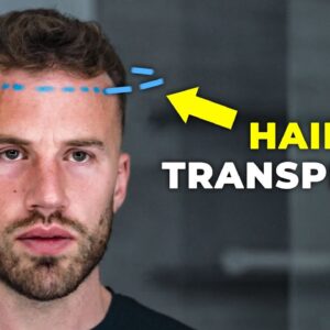 My decision to get a hair transplant (let me explain...)